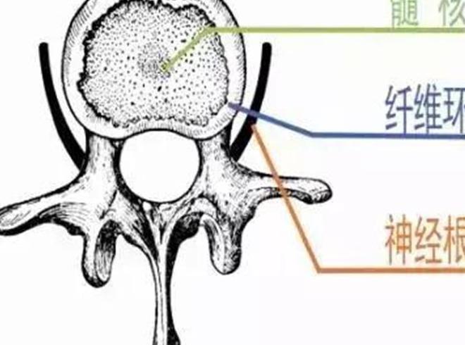 瑜伽教练因长期教习瑜伽导致腰椎间yl8cc永利官网盘突出医生：严重点会瘫痪(图3)