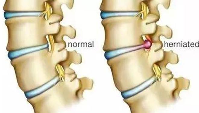 瑜伽教练因长期教习瑜伽导致腰椎间yl8cc永利官网盘突出医生：严重点会瘫痪(图4)